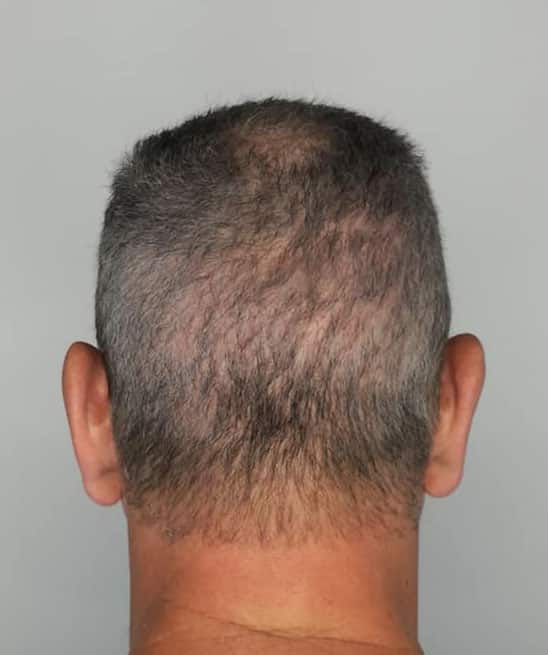 Minoxidil Treatment