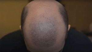 Financing options for hair transplant surgery.