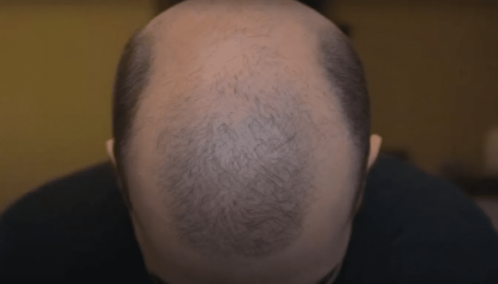 Financing options for hair transplant surgery.