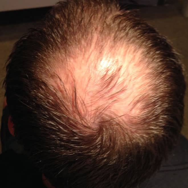 hair transplant before and after