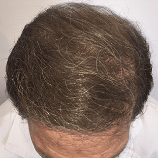 hair transplant before and after